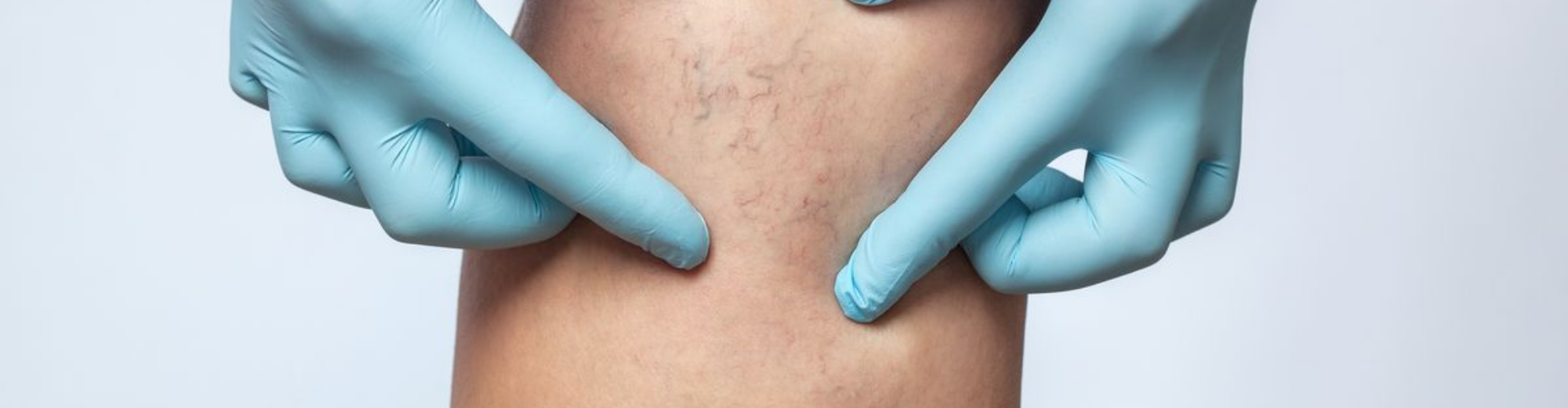 ანგიოქირურგია